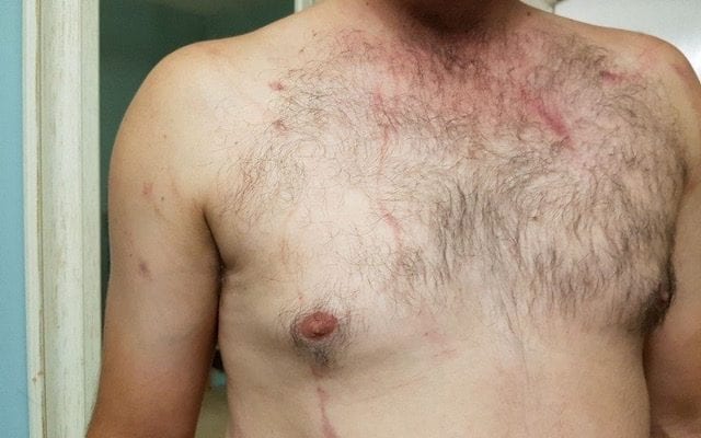 A man's chest with a rash