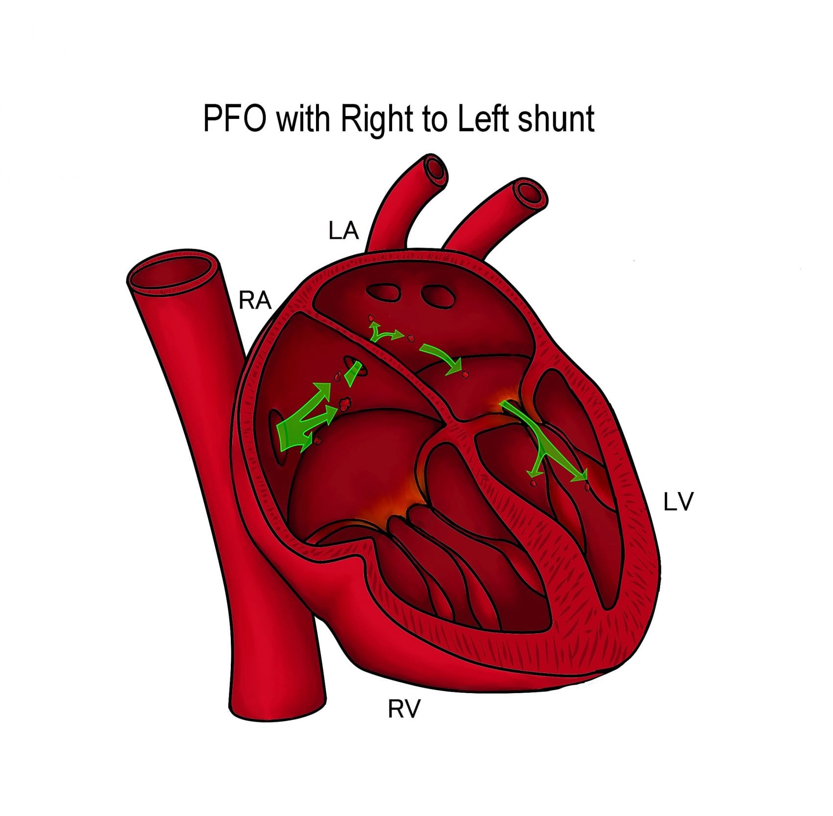 Heart diagram showing PFO with right to left shunt